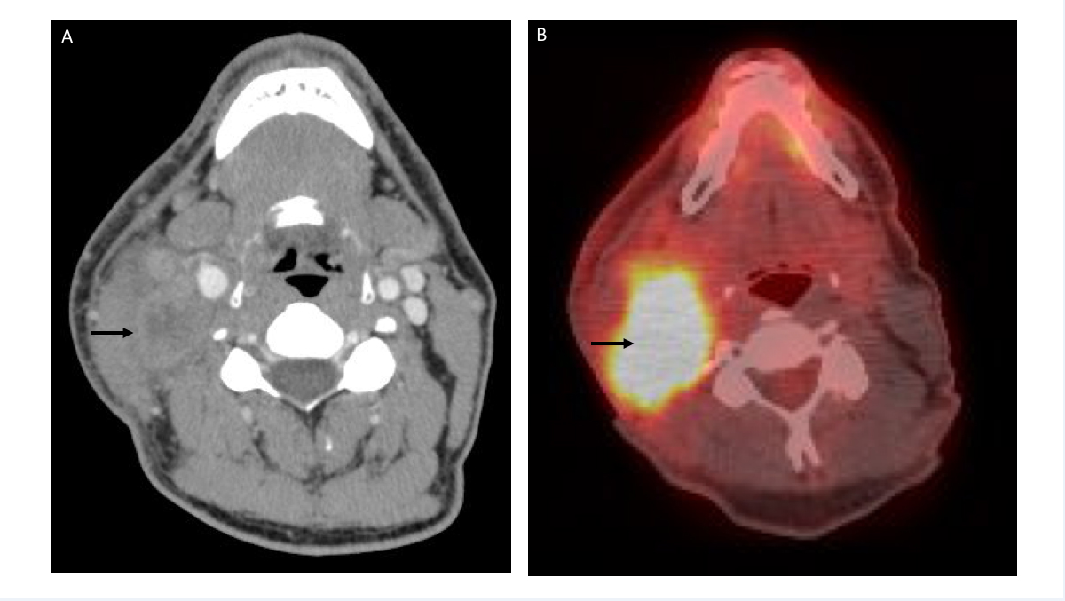 A Case Of Isolated Metastasis To Right Level Ii Cervical Lymph Node