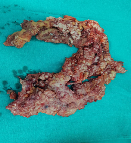 malignant mesothelioma of abdomen icd 10