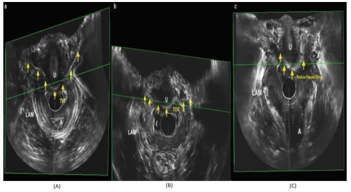 Utility of ultrasound in the diagnosis and location of mid urethral slings