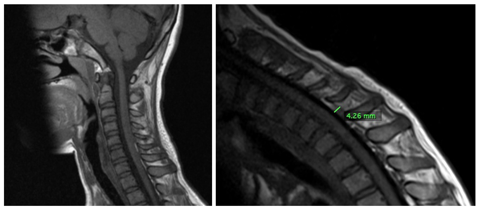 Hirayama Disease: A Report of Two Cases and Review of Imaging Findings